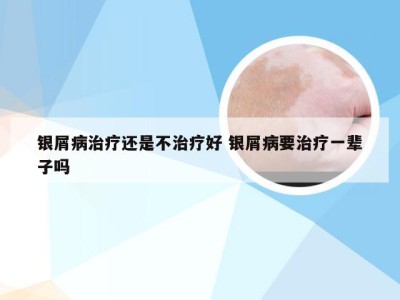 银屑病治疗还是不治疗好 银屑病要治疗一辈子吗