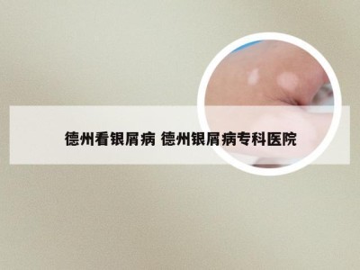 德州看银屑病 德州银屑病专科医院