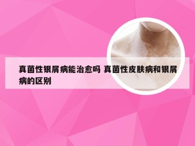 真菌性银屑病能治愈吗 真菌性皮肤病和银屑病的区别