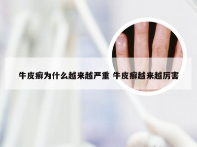 牛皮癣为什么越来越严重 牛皮癣越来越厉害