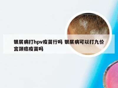 银屑病打hpv疫苗行吗 银屑病可以打九价宫颈癌疫苗吗