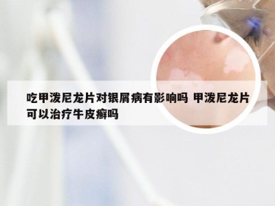 吃甲泼尼龙片对银屑病有影响吗 甲泼尼龙片可以治疗牛皮癣吗