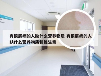 有银屑病的人缺什么营养物质 有银屑病的人缺什么营养物质和维生素