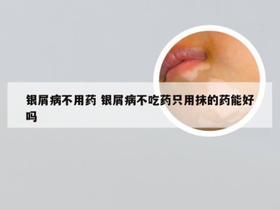 银屑病不用药 银屑病不吃药只用抹的药能好吗