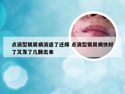点滴型银屑病消退了还痒 点滴型银屑病快好了又发了几颗出来