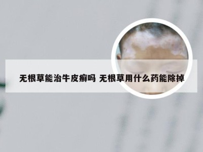 无根草能治牛皮癣吗 无根草用什么药能除掉