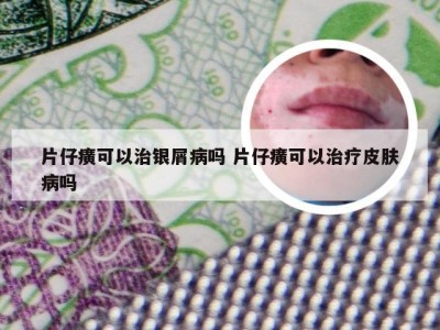 片仔癀可以治银屑病吗 片仔癀可以治疗皮肤病吗