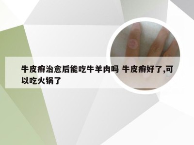 牛皮癣治愈后能吃牛羊肉吗 牛皮癣好了,可以吃火锅了