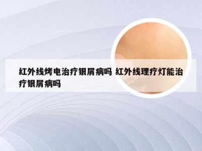 红外线烤电治疗银屑病吗 红外线理疗灯能治疗银屑病吗