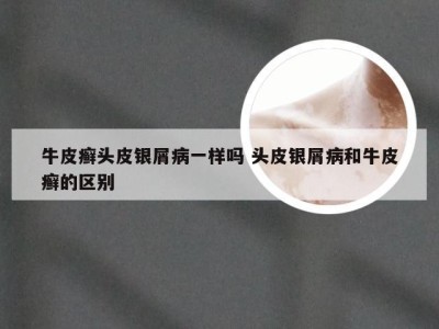牛皮癣头皮银屑病一样吗 头皮银屑病和牛皮癣的区别