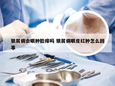银屑病会眼肿脸痒吗 银屑病眼皮红肿怎么回事