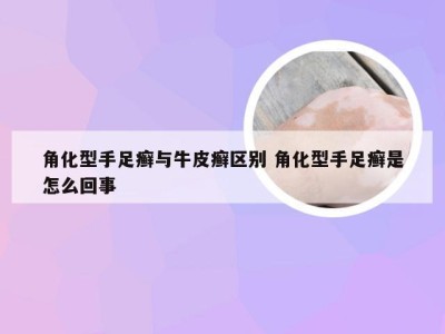 角化型手足癣与牛皮癣区别 角化型手足癣是怎么回事