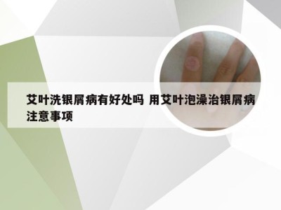 艾叶洗银屑病有好处吗 用艾叶泡澡治银屑病注意事项
