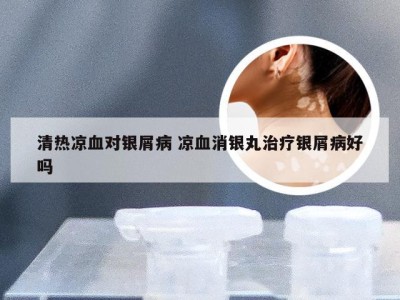 清热凉血对银屑病 凉血消银丸治疗银屑病好吗