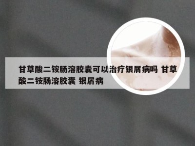 甘草酸二铵肠溶胶囊可以治疗银屑病吗 甘草酸二铵肠溶胶囊 银屑病