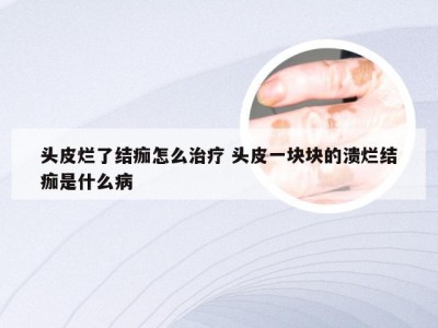 头皮烂了结痂怎么治疗 头皮一块块的溃烂结痂是什么病