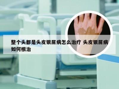 整个头都是头皮银屑病怎么治疗 头皮银屑病如何根治