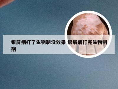 银屑病打了生物制没效果 银屑病打完生物制剂