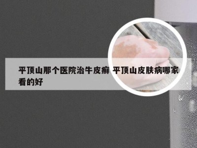 平顶山那个医院治牛皮癣 平顶山皮肤病哪家看的好