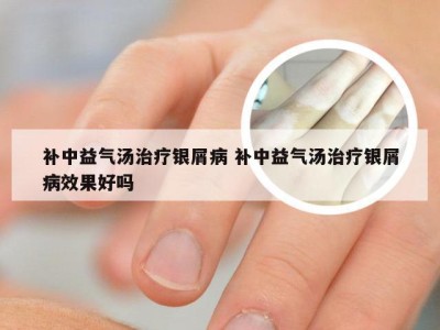 补中益气汤治疗银屑病 补中益气汤治疗银屑病效果好吗