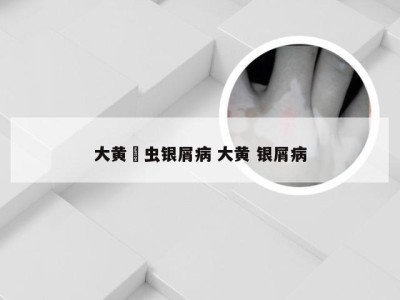 大黄蟅虫银屑病 大黄 银屑病