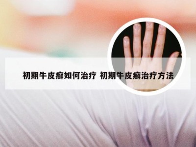 初期牛皮癣如何治疗 初期牛皮癣治疗方法
