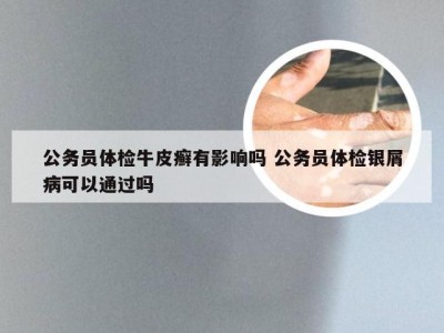 公务员体检牛皮癣有影响吗 公务员体检银屑病可以通过吗