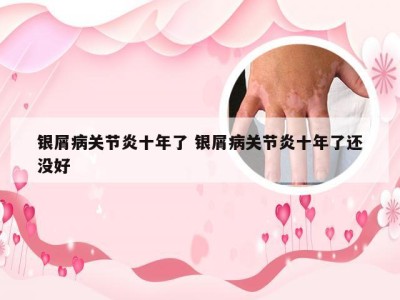 银屑病关节炎十年了 银屑病关节炎十年了还没好