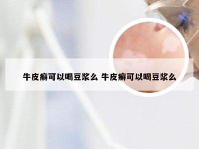 牛皮癣可以喝豆浆么 牛皮癣可以喝豆浆么