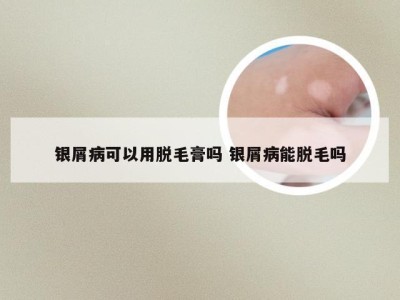 银屑病可以用脱毛膏吗 银屑病能脱毛吗