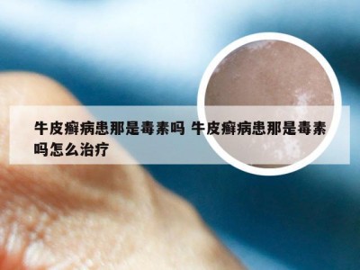 牛皮癣病患那是毒素吗 牛皮癣病患那是毒素吗怎么治疗