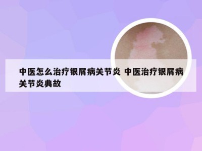 中医怎么治疗银屑病关节炎 中医治疗银屑病关节炎典故