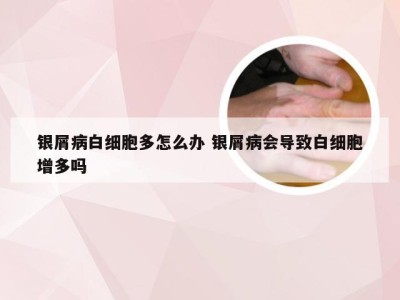银屑病白细胞多怎么办 银屑病会导致白细胞增多吗