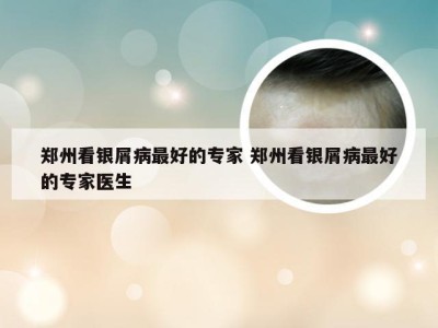 郑州看银屑病最好的专家 郑州看银屑病最好的专家医生