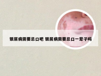 银屑病需要忌口吧 银屑病需要忌口一辈子吗