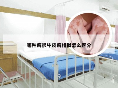 哪种癣很牛皮癣相似怎么区分