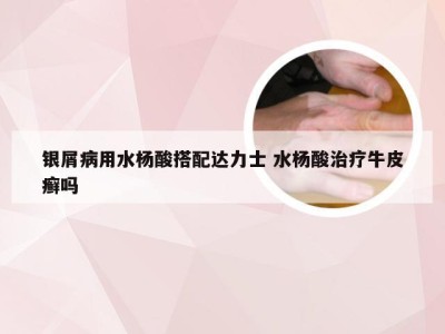 银屑病用水杨酸搭配达力士 水杨酸治疗牛皮癣吗