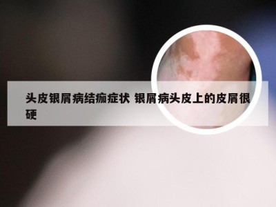 头皮银屑病结痂症状 银屑病头皮上的皮屑很硬
