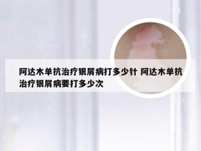 阿达木单抗治疗银屑病打多少针 阿达木单抗治疗银屑病要打多少次