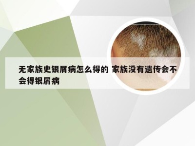 无家族史银屑病怎么得的 家族没有遗传会不会得银屑病
