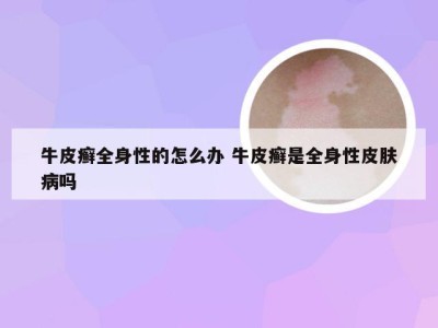 牛皮癣全身性的怎么办 牛皮癣是全身性皮肤病吗