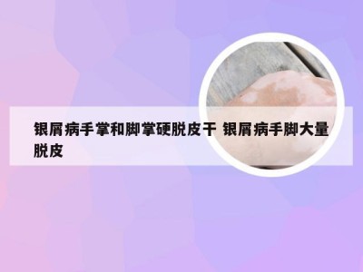 银屑病手掌和脚掌硬脱皮干 银屑病手脚大量脱皮