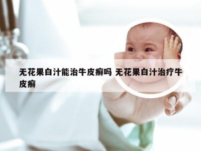 无花果白汁能治牛皮癣吗 无花果白汁治疗牛皮癣