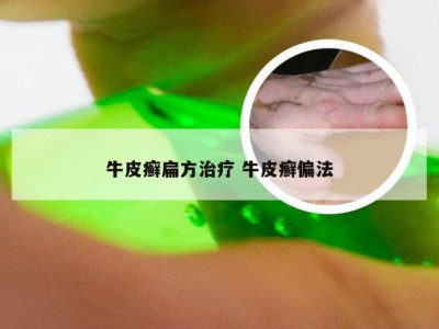 牛皮癣扁方治疗 牛皮癣偏法
