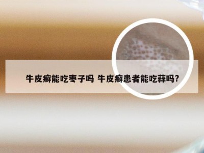 牛皮癣能吃枣子吗 牛皮癣患者能吃蒜吗?
