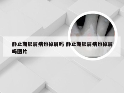 静止期银屑病也掉屑吗 静止期银屑病也掉屑吗图片