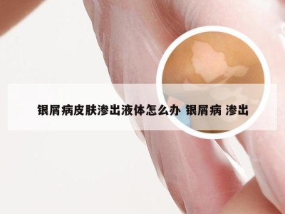 银屑病皮肤渗出液体怎么办 银屑病 渗出