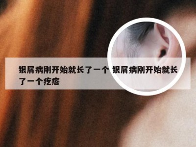 银屑病刚开始就长了一个 银屑病刚开始就长了一个疙瘩