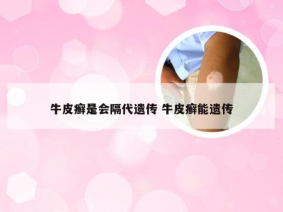 牛皮癣是会隔代遗传 牛皮癣能遗传