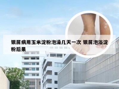银屑病用玉米淀粉泡澡几天一次 银屑泡浴淀粉后果